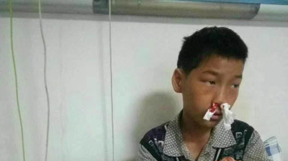 小孩流鼻血会是白血病?