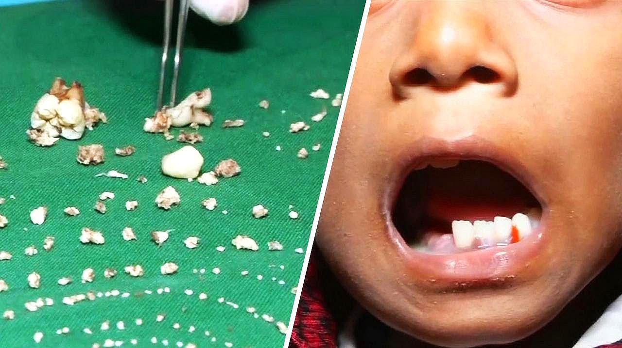 印度男孩嘴里长526颗牙齿,医生都难以置信:世界罕见!